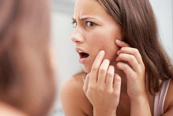acne-bouton-soin-huile-vegetale